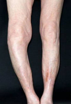 При болезни Педжета ноги приобретают Xили О-образную форму